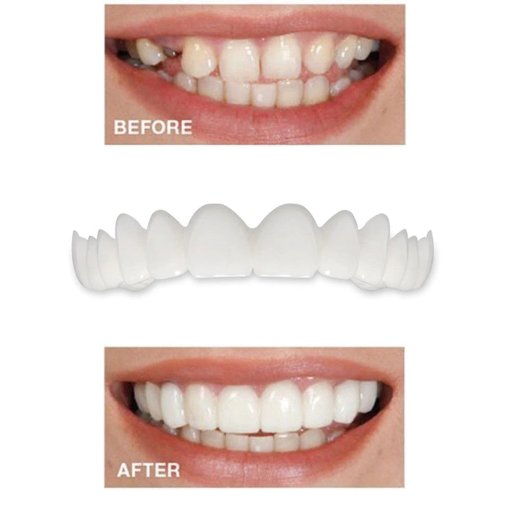 2 Pcs Snap On Veneers – Instant Smile Transformation for Confidence | Upper and Lower Teeth Cover 5