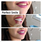 2 Pcs Snap On Veneers – Instant Smile Transformation for Confidence | Upper and Lower Teeth Cover 6