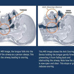 Anti Snoring Tongue Stabilizing Device - Best Anti Snoring Mouthpiece for Sleep Apnea Relief 3