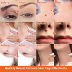 Auto Skin Tag Remover Kit – Best Skin Tag Remover for Painless & Efficient Skin Tag Removal 4