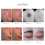 Picosecond Laser Remover for Tattoos and Dark Spots - Professional Precision 7
