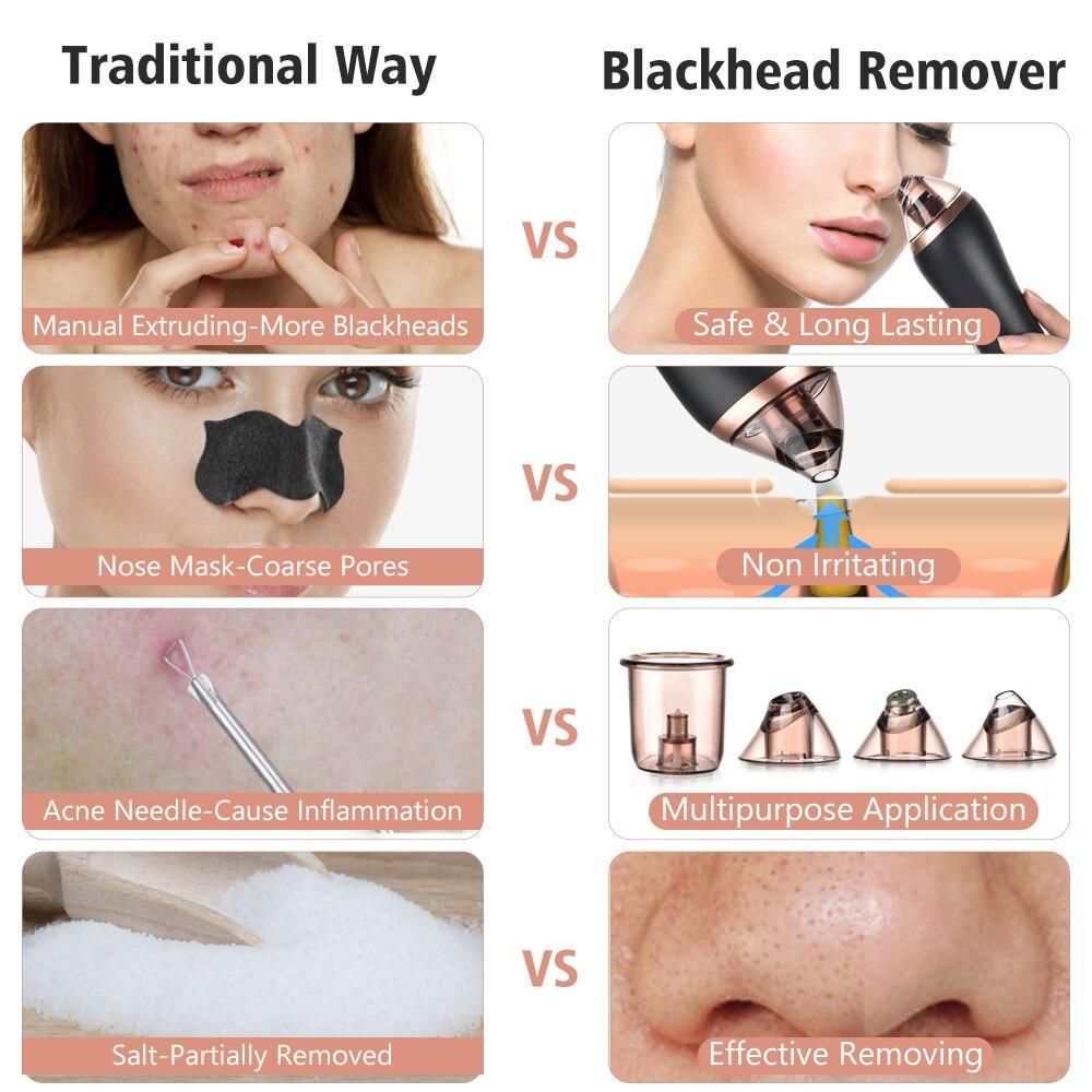 4 in 1 Body Guasha Cupping Blackhead Remover Machine