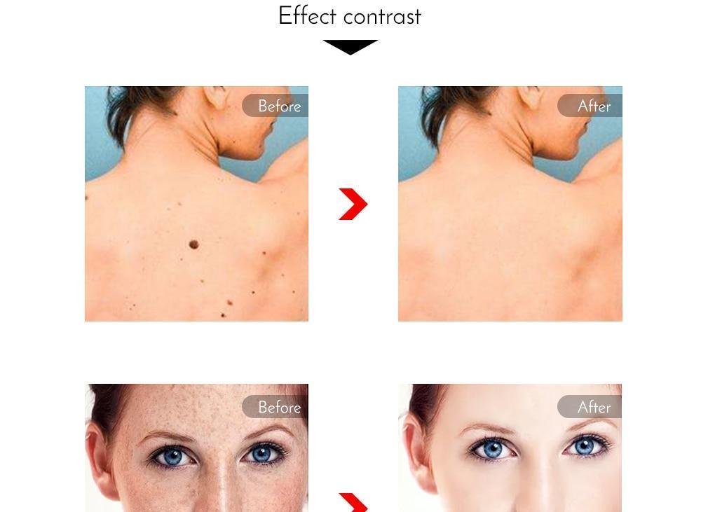 Professional Laser Pen Tattoo Removal, Mole, Freckles, Acne removal
