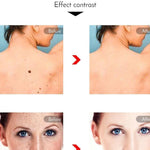 Professional Laser Pen Tattoo Removal, Mole, Freckles, Acne removal